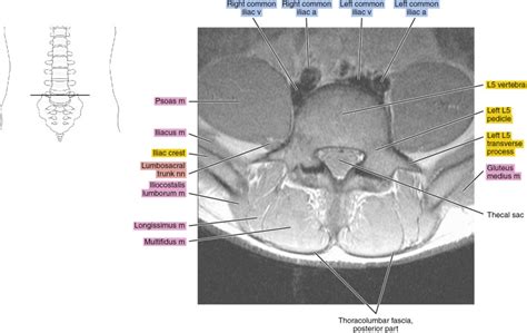 Mri Of The Lumbar Spine Radiology Key