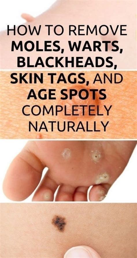 How To Remove Moles Warts Blackheads Skin Tags And Age Spots