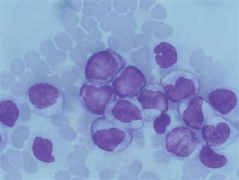 Peripheral Blood Numerous Monoblasts And Promonocytes Pappenheim