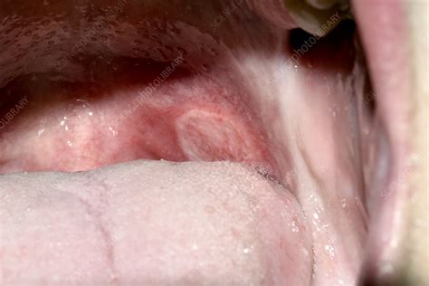 Canker Sore Stock Image C0286682 Science Photo Library