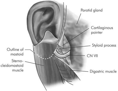 Surgical Landmarks For Identification Of Facial Nerve In Parotid
