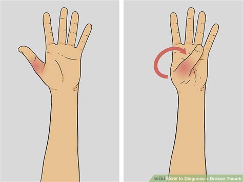 Get medical advice as soon as possible if you think you have broken a finger or thumb. How can you tell if you have a broken thumb - NISHIOHMIYA ...