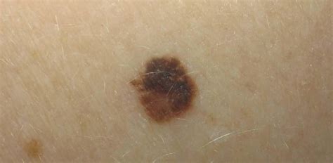 The Stages Of Melanoma Development Critical Health Information You