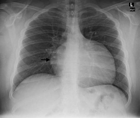 Figure Chest Radiograph Showing Enlarged Cardiomediastinal Silhouette