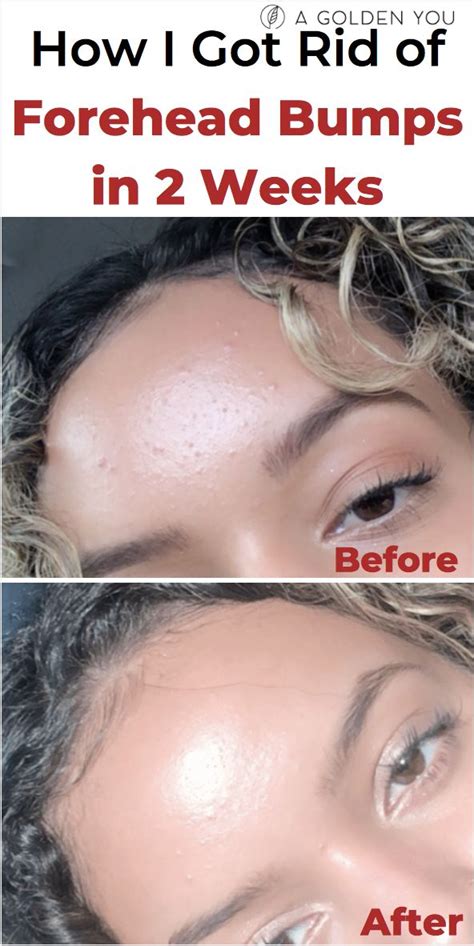 How I Got Rid Of Forehead Bumps In 2 Weeks Acnetreatment Fungalacne Skincare Forehead