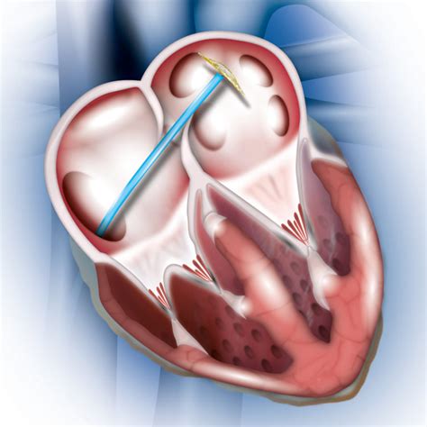 Heart Defect Pfo Occlutech Every Beat Counts