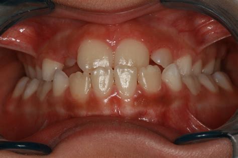 Clase Iii Maloclusiones En Ortodoncia Clínica Dental Larrañaga