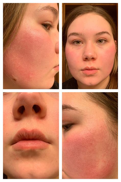 Skin Concerns Looking For Help Determining What The Redness On My