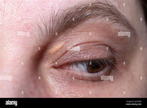 Xanthelasma Elevated Yellowish Growth On The Eyelids Macro Shot Stock