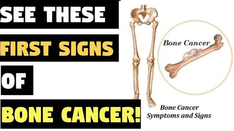 Bone cancer destroys normal bone tissue. If You See These First Signs, You Are Developing Bone ...