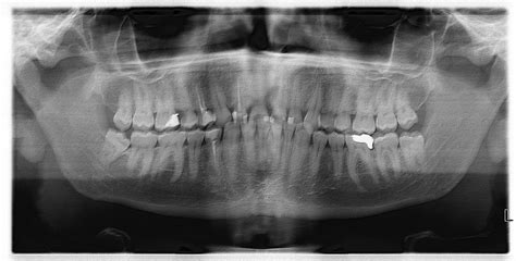 Is My Severe Radiating Teeth Pain Neurological Askdocs