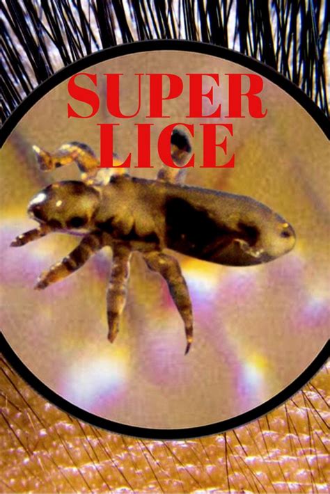 Learn How To Get Rid Of Super Lice Louse Lice Prevention Prevention