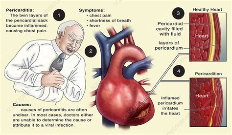 Pericarditis Symptoms Pathophysiology Causes Diagnosis And The Best