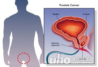 How is prostate cancer diagnosed? 防攝護腺癌 40歲起應每年指診 - uho優活健康網