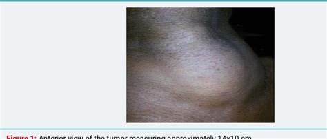 Figure 1 From Giant Lipoma Anterior Neck A Case Report Semantic Scholar