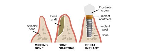 Bone Graft Surgery Surrey Bc Bone Grafting For Dental Implants