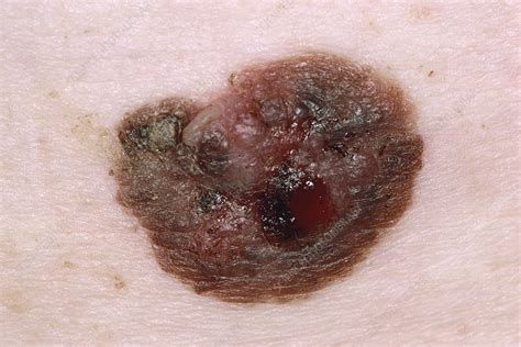 Nodular Melanoma On A Superficial Spreading Melanoma Stock Image