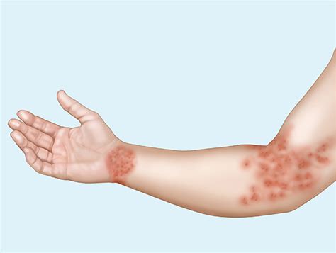Contact dermatitis rash (picture 2) is characterized by the appearance of puffiness, and eventually small papules on the inflamed skin, constantly itching. Nummular Eczema: Causes, Symptoms, and Diagnosis