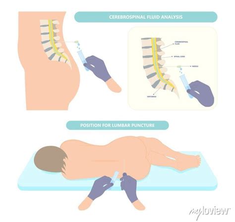 Lumbar Puncture For Infalmmation Bleeding Cancer Brain Inject Posters