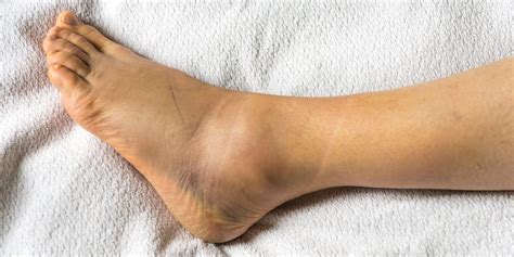 Sharp pain on top of the foot, near your toes, could be the symptoms of extensor tendonitis. 12 Causes of Swollen Ankles, Feet - Why Are My Ankles Swollen
