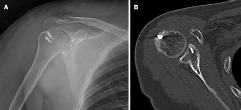 Treatment Of A Rotator Cuff Tear Combined With Iatrogenic Glenoid