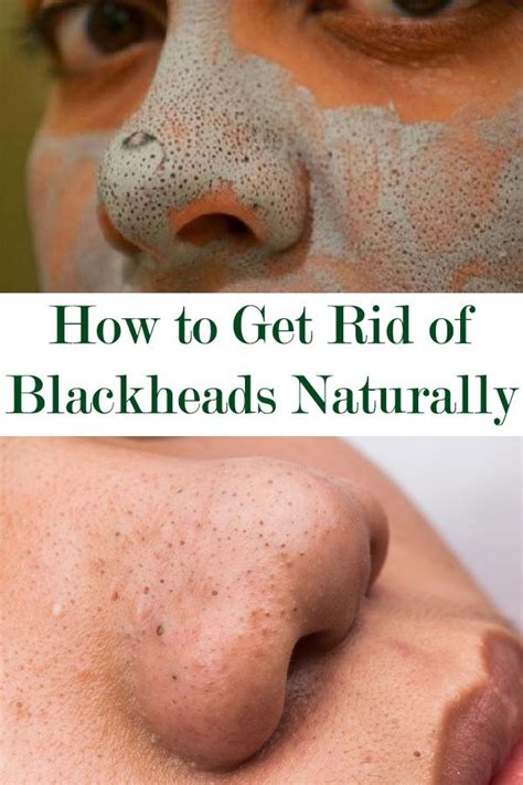 So if your skin has been. How to Get Rid of Blackheads Naturally - My Little Beauty ...