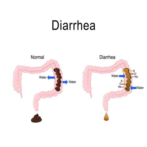 Diarrhea In Practice Case 4 Medical Practice Medicalbrandnames
