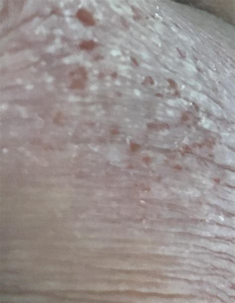 Anyone Know What This Is Rdermatologyquestions