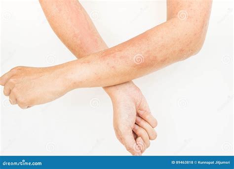 Skin Rashes Allergies Contact Dermatitis Allergic To Chemicals Stock