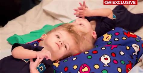 Twins Conjoined At Head Successfully Separated After 27 Hour Operation In New York