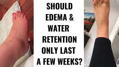How Long Should Edema Last In Recovery