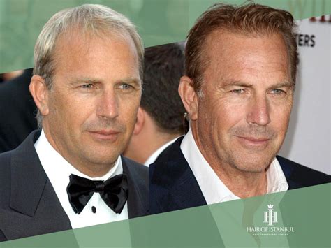 The Kevin Costner Hair Transplant Controversy A Closer Look