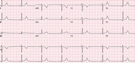 Sinus rhythm with a resting heart rate of < 60 bpm in adults, or below the normal range for age in children. Bradycardia - Sinus Bradycardia Causes, Symptoms ...
