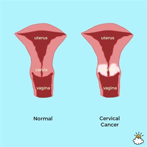 Cervical Cancer Signs And Symptoms Every Woman Needs To Know Forgot
