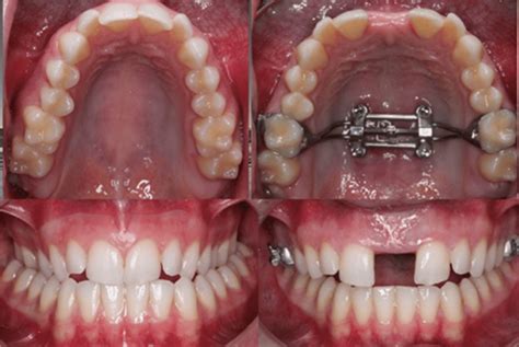 Everything You Need To Know About Palatal Expanders In Orthodontics Family Braces