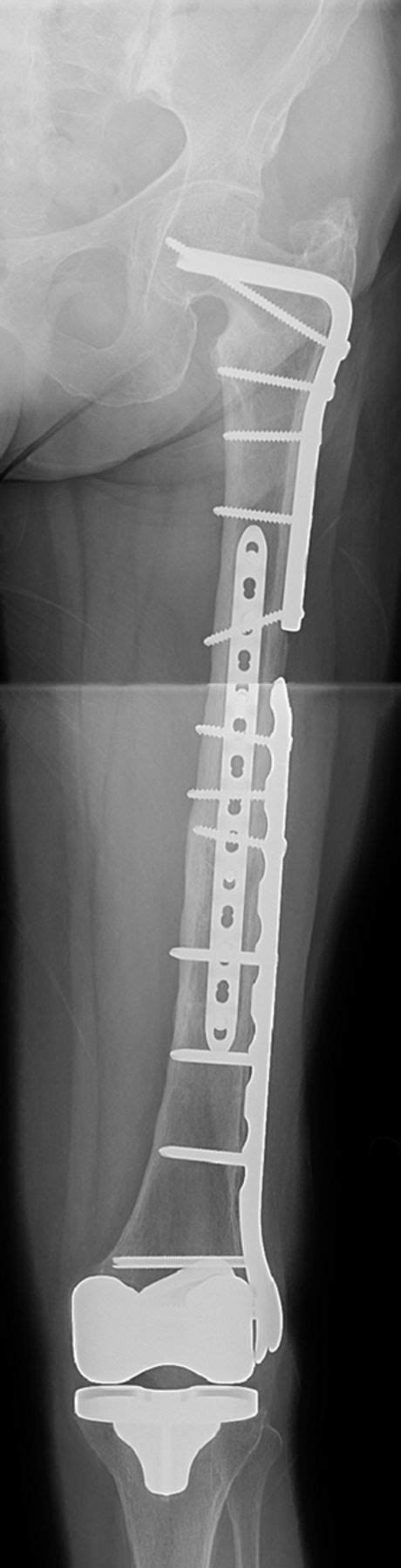 Orthogonal Femoral Plating Bone And Joint