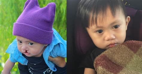 Celah bibir inferior sangat jarang terjadi, dan biasanya terletak tepat di tengah dan disebabkan oleh ketidaksempurnaan penyatuan prominensia mandibularis. "Kenapa Nak Malu, Ukail Dah Handsome.. Semangat Ukail Buat ...