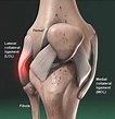 Lateral Collateral Ligament Injuries - Idaho Sports Medicine Institute