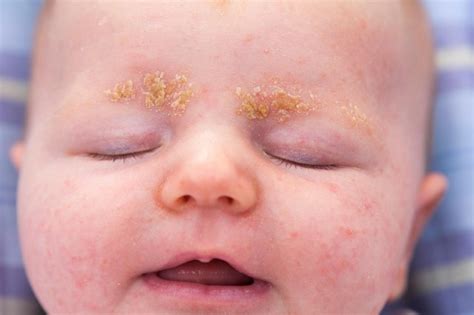 4 Natural Cradle Cap Cures