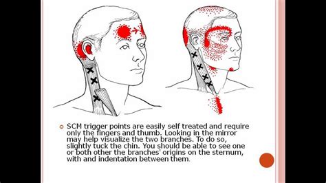 Head Eye And More Pain From Sternocleidomastoid Muscle Trigger Points
