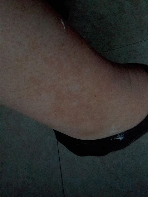 I Have These Red Dotsblotches All Over My Legs Non Itchy Please Help