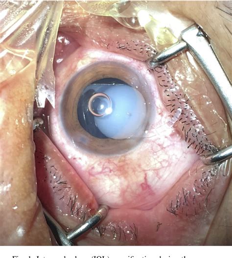 Figure From Transient Intraocular Lens Opacification During