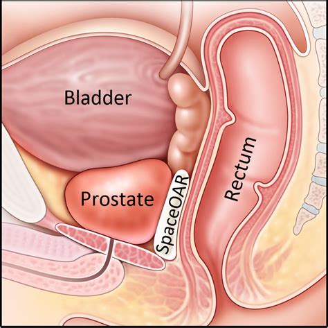 Die funktion der prostata wird über das hormon testosteron reguliert. Augmenix Announces New Category 1 CPT Code for ...