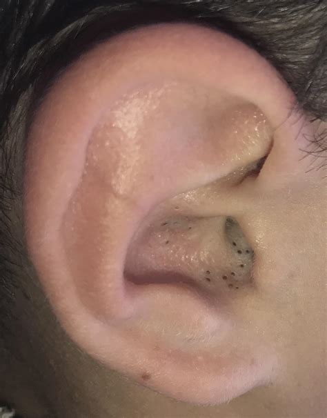both my brother’s ears are filled with blackheads, but he won’t let me