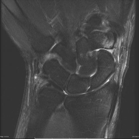 Those with tfcc tear had a higher power doppler (pd) ultrasound score and higher disease in the distal radioulnar joint, the triangular fibrocartilage complex (tfcc) is an important stabilizer. Triangular fibrocartilagenous complex tear | Image ...