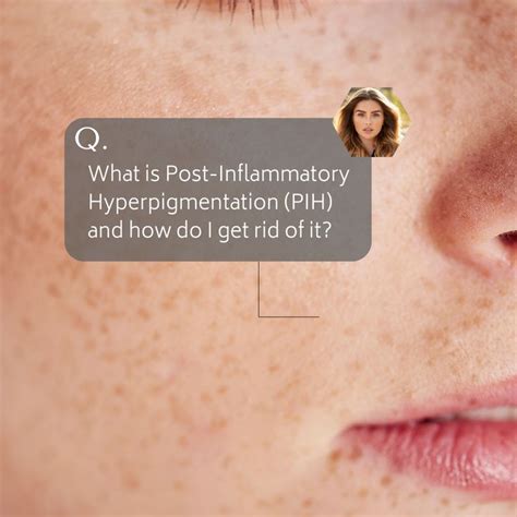 What Is Pih Post Inflammation Hyperpigmentation And How To Tre