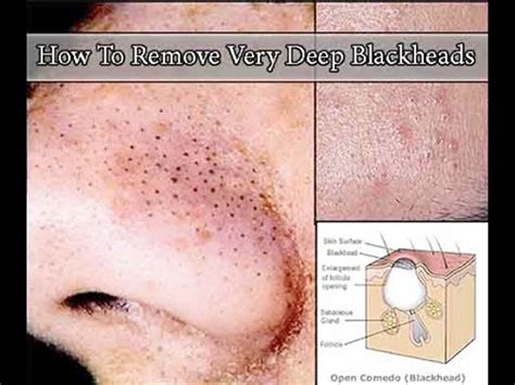 The best blackheads removal products contain certain ingredients. Blackhead | Natural Treatment for Blackhead