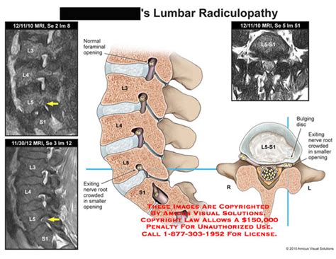 AMICUS Illustration Of Amicus Injury Lumbar Radiculopathy Normal