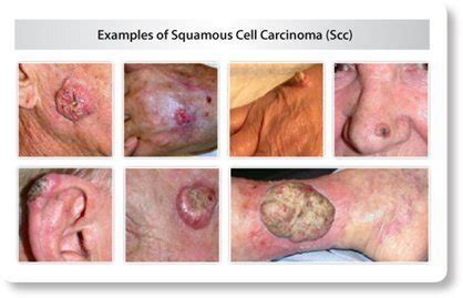 What does the term, in situ mean? What is an SCC (Squamous Cell Carcinoma)?