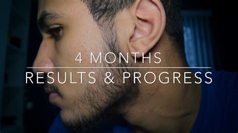 8 minoxidil beard before and afters. Minoxidil Beard: 4 Months Results & Progress - My Beard Oil Company | IHazADream - YouTube
